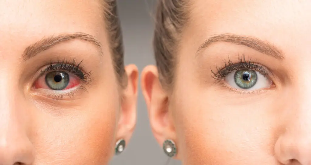 Close-up of two women’s faces; one has a red irritated eye, the other has a healthy-looking eye.